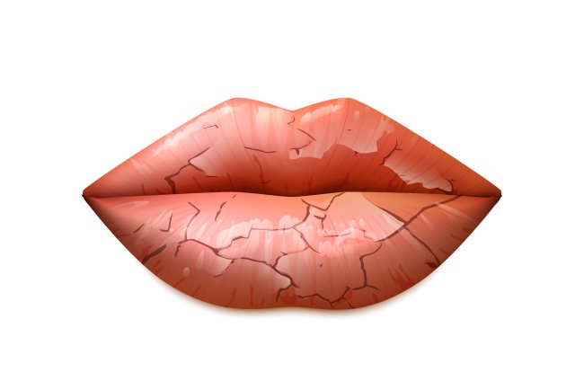 Droge lippen: oorzaken, klachten en oplossingen